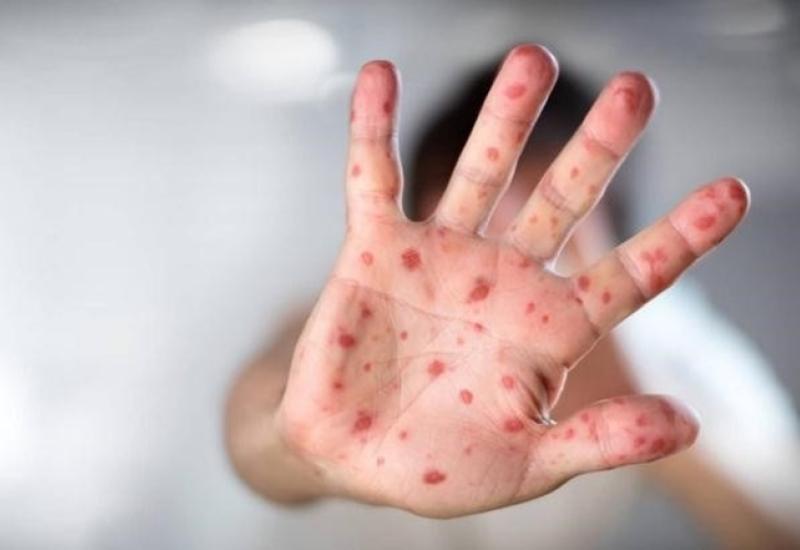 Cách phòng bệnh tay chân miệng ở trẻ